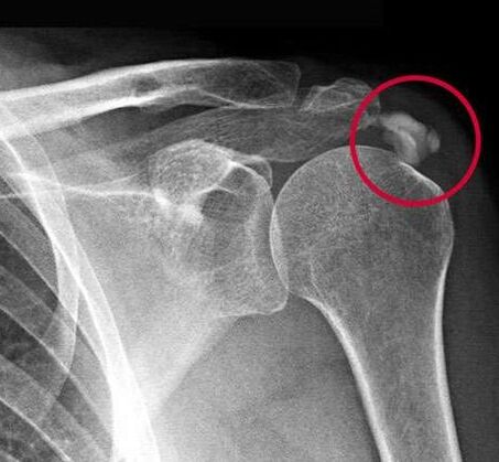 Röntgenfoto toonde afzettingen van calciumzouten in het gewricht
