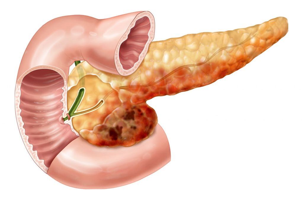 rugpijn als gevolg van pancreatitis