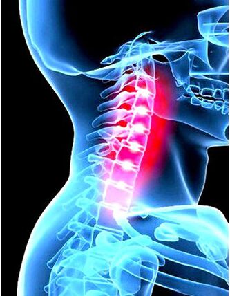 Klinisch beeld van osteochondrose